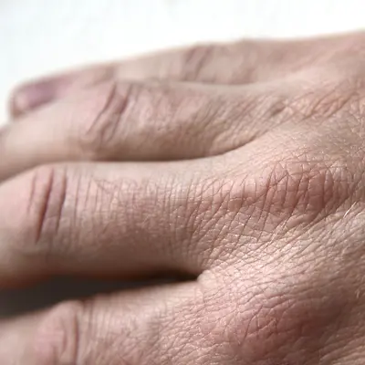 Skin ageing