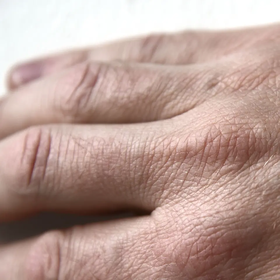 Skin ageing